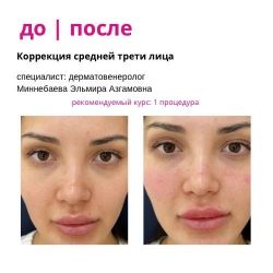 Коррекция средней трети лица препаратом NEAUVIA INTENSE Специалист Миннебаева Эльмира Азгамовна.