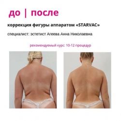 Вакуумной-роликовый массаж аппаратом «STARVAC» Специалист - Агеева Анна Николаевна