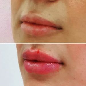 BELOTERO LIPS коррекция губ