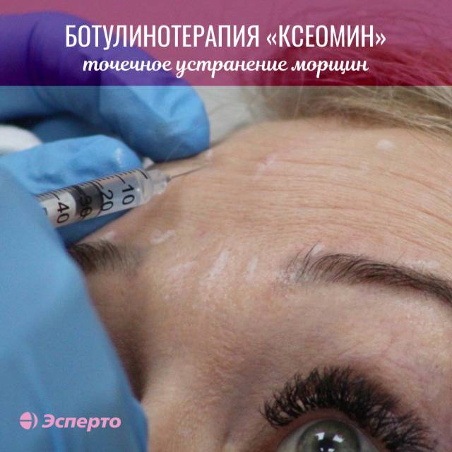Точечное устранение морщин препаратом Ксеомин