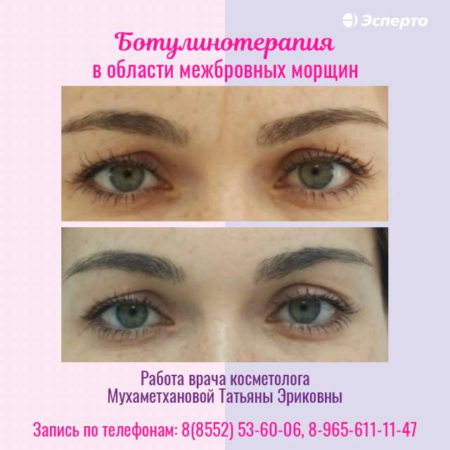 Приглашаем на процедуру ботулинотерапия в клинику «Эсперто»!