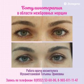 Приглашаем на процедуру ботулинотерапия в клинику «Эсперто»!