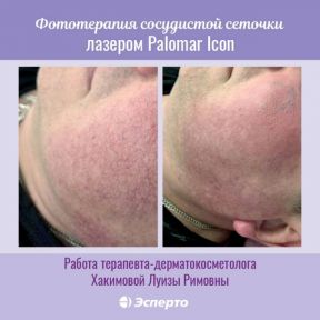 Фототерапия сосудистой сеточки лазером Palomar Icon