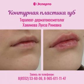 Контурная пластика губ
