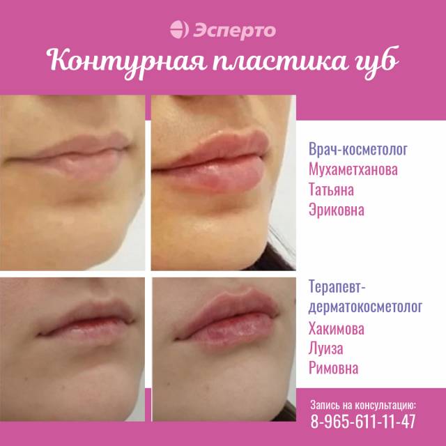 Контурная пластика губ в клинике «Эсперто»
