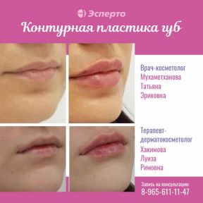 Контурная пластика губ в клинике «Эсперто»