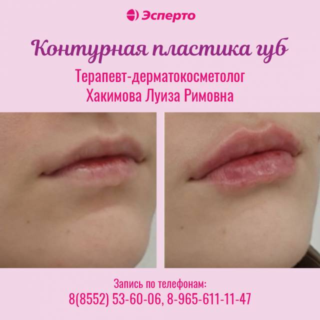 Контурная пластика губ в клинике «Эсперто»