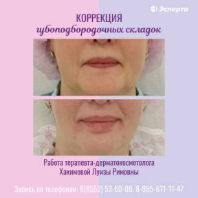 Коррекция губоподбородочных складок в клинике «Эсперто»