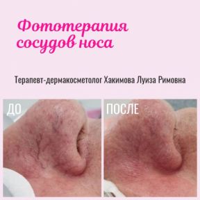 Боретесь с куперозом? Мы знаем решение!