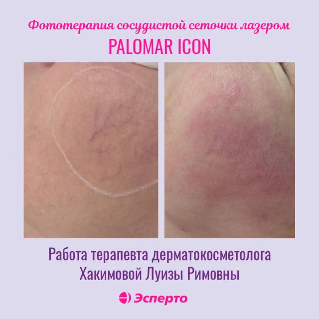 Удаление сосудов на современном американском аппарате Palomar Icon
