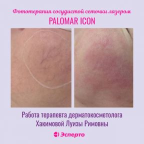 Удаление сосудов на современном американском аппарате Palomar Icon