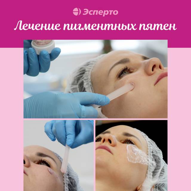 Лечение пигментных пятен в клинике «Эсперто»