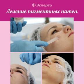 Лечение пигментных пятен в клинике «Эсперто»