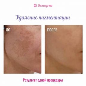 Здоровая кожа: мы убираем пигментацию!