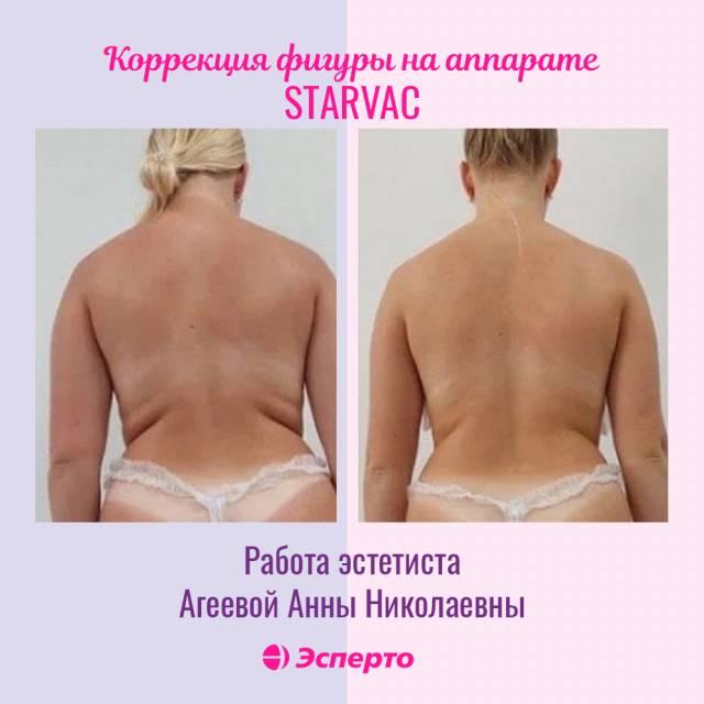 Вакуумно-роликовый массаж Starvac для идеальной фигуры
