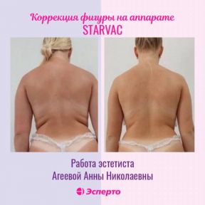 Вакуумно-роликовый массаж Starvac для идеальной фигуры