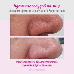 Удаление сосудов на лице лазером премиального уровня Palomar Icon