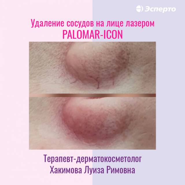 Удаление сосудов на современном американском аппарате Palomar Icon