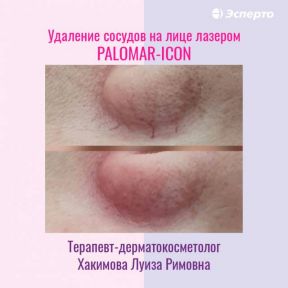 Удаление сосудов на современном американском аппарате Palomar Icon