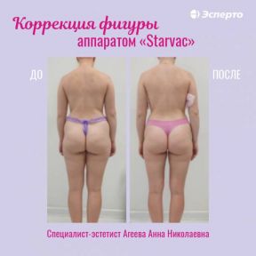 Коррекция фигуры аппаратом «Starvac» в клинике «Эсперто»