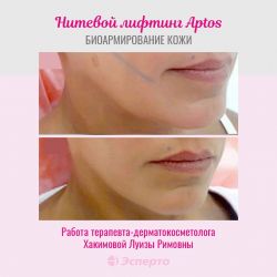 Нитевой лифтинг Aptos: терапевт-дерматокосметолог Хакимова Луиза Римовна