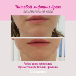 Нитевой лифтинг Aptos (биоармирование кожи). Работа врача косметолога Мухаметхановой Татьяны Эриковны