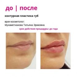 Контурная пластика губ. Врач-косметолог Мухаметханова Татьяна Эриковна.