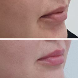 Коррекция губ препаратами НЬЮВИА и СТИЛАЖ. Врач-косметолог Мухаметханова Т.Э.