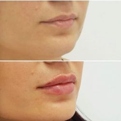 Коррекция губ, врач-косметолог Мухаметханова Т.Э.
