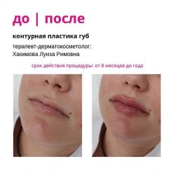 Контурная пластика губ, увеличение. Специалист: Хакимова Луиза Римовна.