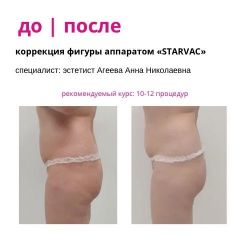 Вакуумно-роликовый массаж на аппарате «Starvac»